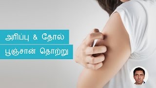 Skin Fungal Infections Symptoms, Causes, Treatments | Tamil