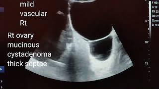 Bilateral large cystadenoma of ovaries with healthy pregnancy, ultrasound and color Doppler video