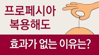 탈모약 프로페시아가 효과가 없는 4가지 경우