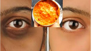 home remedies for removing dark circle# karuvalayam pokka#remove dark circle permanently