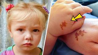 Mom Adopts Girl With Same Birthmark - She Screams When She Sees DNA Test Results