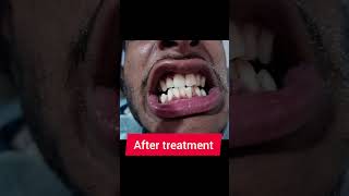 stain removing scaling treatment #drkapilsaini #drjyotisuman #dentalclinic