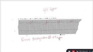 EKG Review Part 1