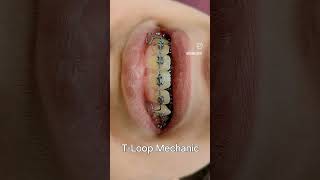 T Loop |دکتر احسان ابوئی مهریزی