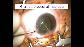 Cataract coaxial surgery 👁️