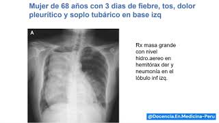 Neumonía e incidentaloma en RX - Dr Jorge Casas Castañeda