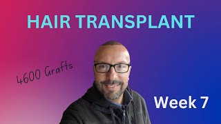 Hair Transplant in Turkey - 7 week update - the dreaded shedding phase!