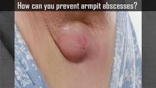 Armpit Abscess!  Infections / Axillary Infection