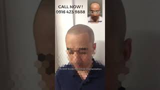 Scalp Microhair Pigmentation done by IS SMP Philippines not ordinary Hair Tattoo