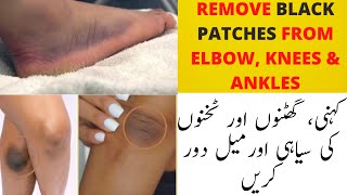 Dark Elbows Dark Knees and Dark Ankles Home Solution | Dark Knees & Dark Elbows | Dark Black Ankles