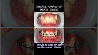 Amazing Orthodontics, before & after result. #cebudentist #dentalclinic #dentalbraces #orthodontics