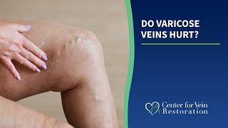 Do Varicose Veins Hurt?