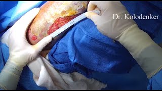 Chronic leg wound surgical debridement and application of Integra Bilayer