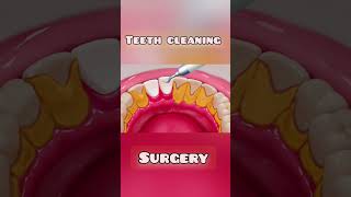 3D Yellow Teeth Cleaning