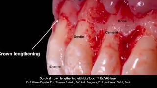 Surgical crown lengthening with LiteTouch™ Er:YAG laser