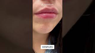 Dr. Alejandro Acuña | Relleno de labios con ácido hialurónico