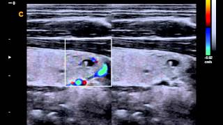 Chison Qbit ThyroidC 2-Amazing Image with Color Doppler Ultrasound