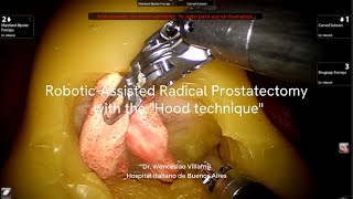 Hood Technique for Robotic Radical Prostatectomy