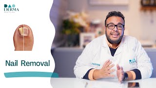 Dao Derma | إزالة الأظافر