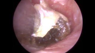 Hard and Impacted Ear Wax removed from Ear Canal and Eardrum