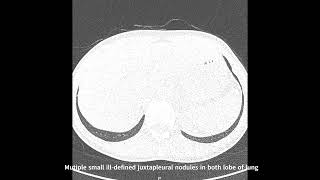 [Low dose Chest CT] mutiple small ill-defined juxtapleaua nodules in both upper lobes