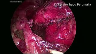 Laparoscopic Fundoplication for large hiatus hernia with combined sliding and rolling components