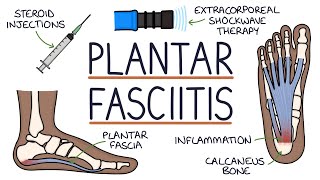 Understanding Plantar Fasciitis