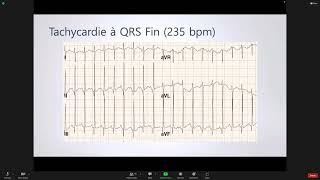 Tachycardie Atriale   PROF David j  Bradley  27 10 2022