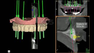 I2  BDS Guided Surgery Full Arch