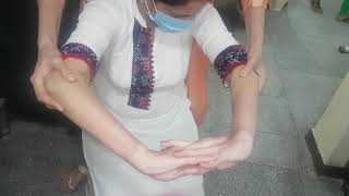 #RheumatoidArthritis(Video-2) #R.A. #HandDeformities #गठिया