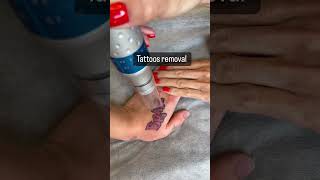 Tattoo Removal #trending #ytshorts #shorts #tattooremoval #youtube #viral #viralvideo