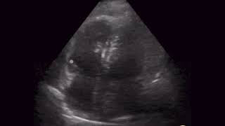 Right Ventricular Strain in Pulmonary Embolism  (Apical)