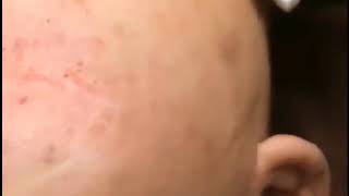 How to remove many blackheads and clear milia