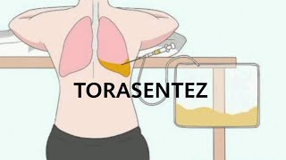 TORASENTEZ UYGULAMASI