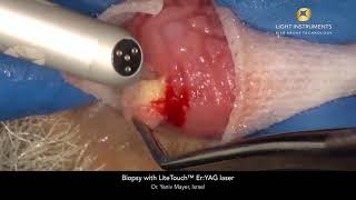 Biopsy with LiteTouch™ Er:YAG laser