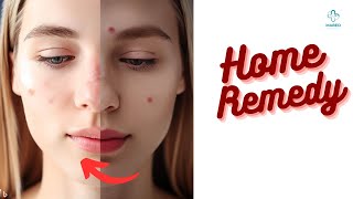 Say Goodbye to Acne Naturally! Effective Home Remedies