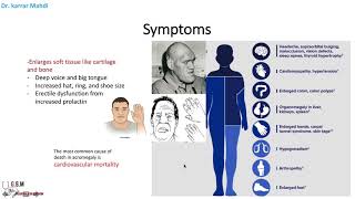 6 Acromegaly