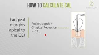 Dentiscope | HOW TO DETERMINE CLINICAL ATTACHMENT LOSS