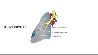 Ghon’s complex pathology mbbs