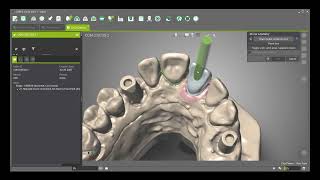 DWOS - Create an ASC (Angulated Screw Channel)