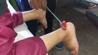 Delayed relaxation of ankle jerk in hypothyroidism | #jerk #ankle