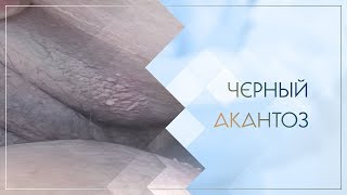 Черный акантоз. Клинический случай №15