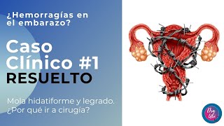 Qué pasa si tengo un tumor? 🤯 Caso Clínico Mola hidatiforme | Dra. Ubi