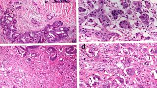 High-fat diet proven to fuel prostate cancer progression by imitating a key cancer alteration