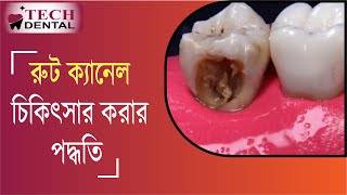 রুট ক্যানেল চিকিৎসার পদ্ধতি ।। Root Canal Treatment Procedure ।। Tech Dental