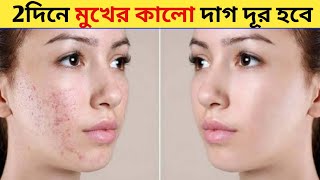 মুখের কালো দাগ দূর করার উপায়  | Dark spot remove in 2 days #darkspots