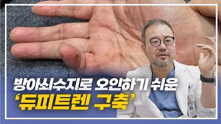 [털보의사] 방아쇠수지와 증상이 비슷해서 오인하기 쉬운 '듀피트렌 구축' 에 대해서 알아봅시다.