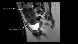 Fibroids Case 1