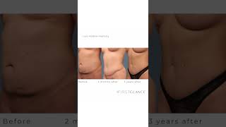 AMAZING SCAR PROGRESSION FOR TUMMY TUCK