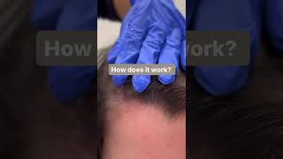 Plasma Hair Restoration | PRP Treatments | Hair Loss Treatment | Bare Medical Spa